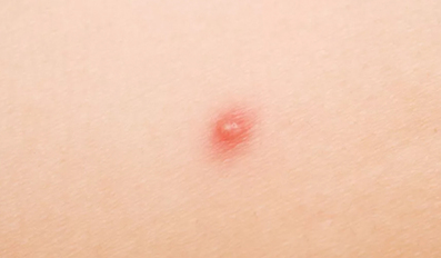 Causes of Little Red Dots on Skin Things You Need To Know